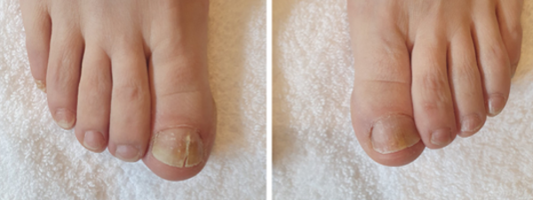 Traitement Mycose De L'ongle 12