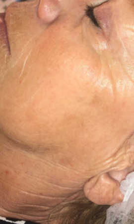 Taches Pigmentaires 2