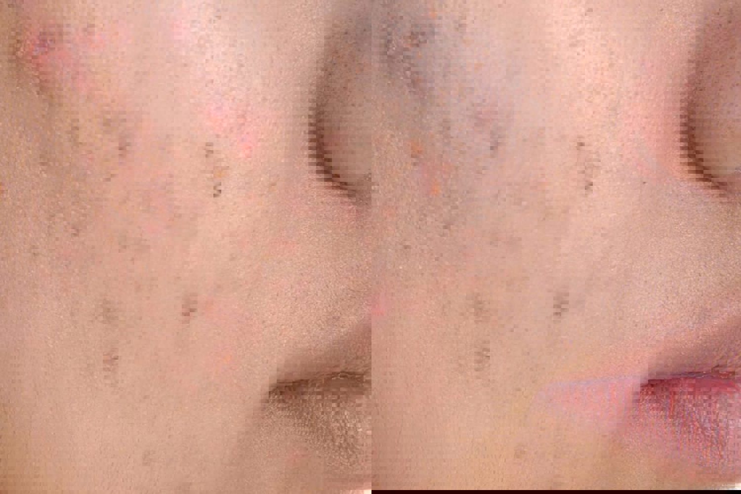 Acne Hygiëne