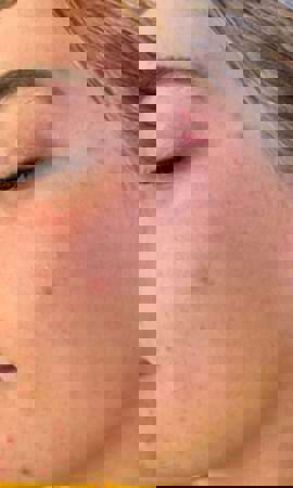 Akne Nach 2 Behandlungen