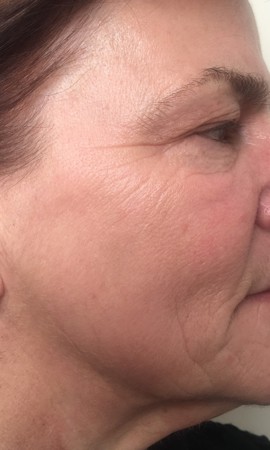 Resultaat Huidverstrakking Na 3