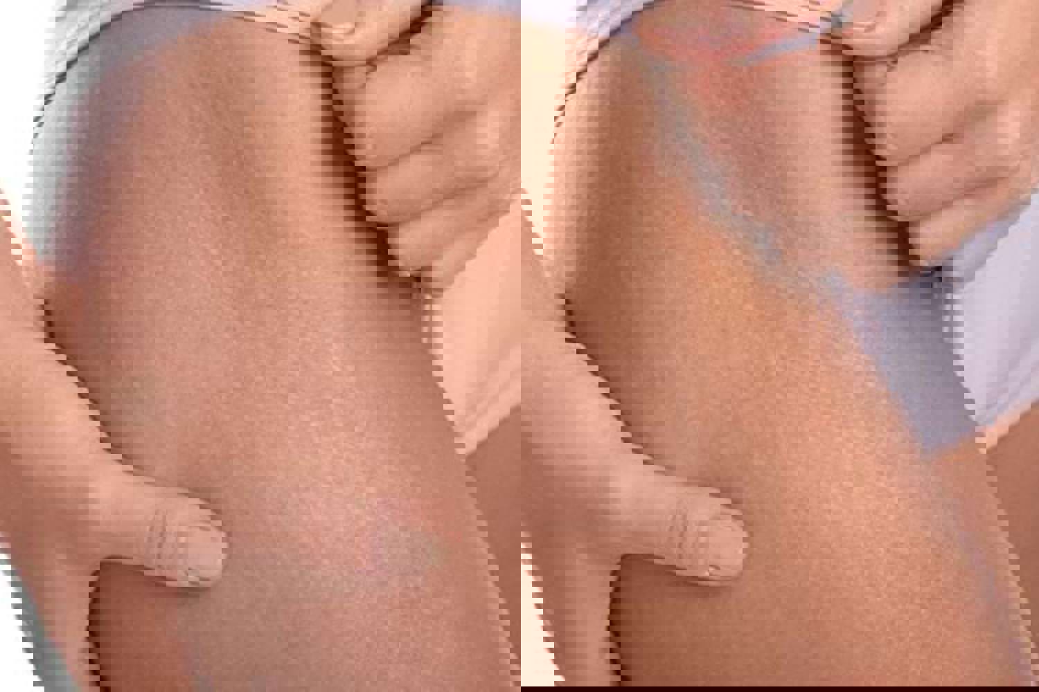 CICATRICES ET VERGETURES