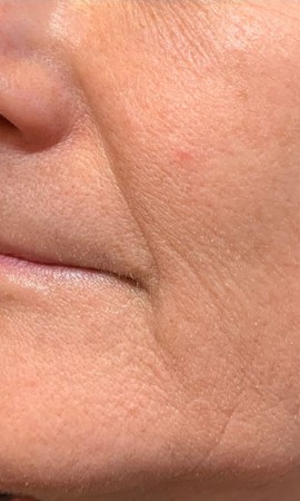 Resultaat Rimpelbehandeling 1 (2)