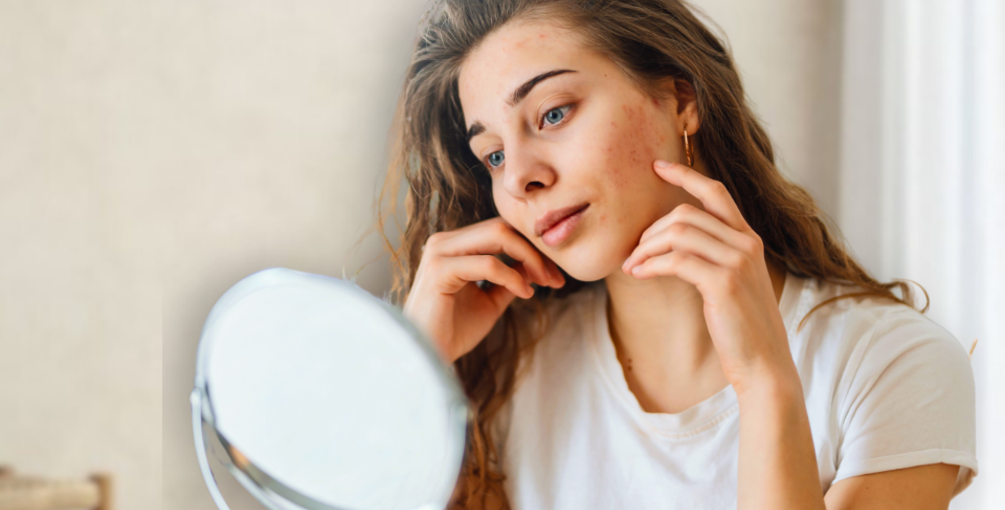 Meisje met rosacea kijkt in de spiegel en wilt graag een behandeling hiertegen