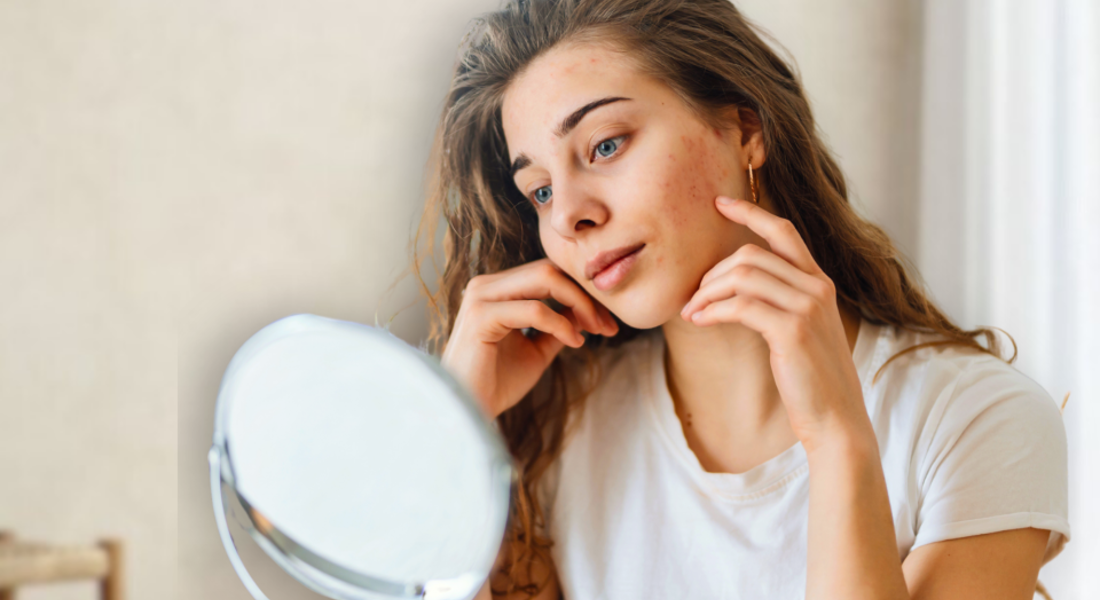 Rosacea Behandeling