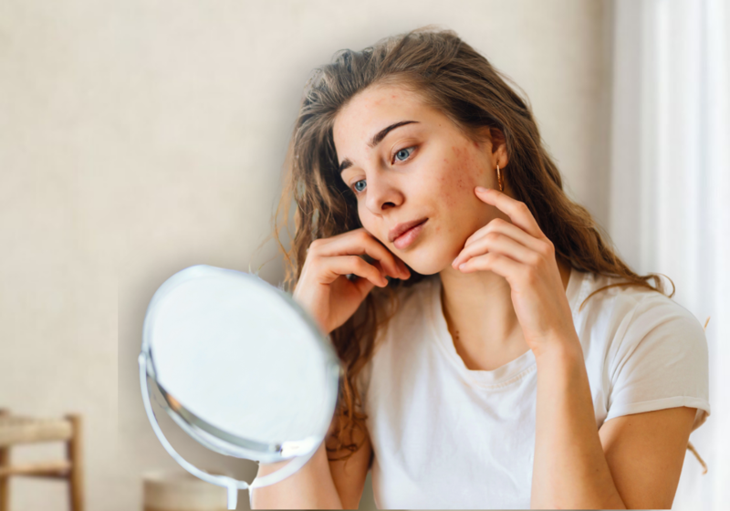 Meisje met rosacea kijkt in de spiegel en wilt graag een behandeling hiertegen