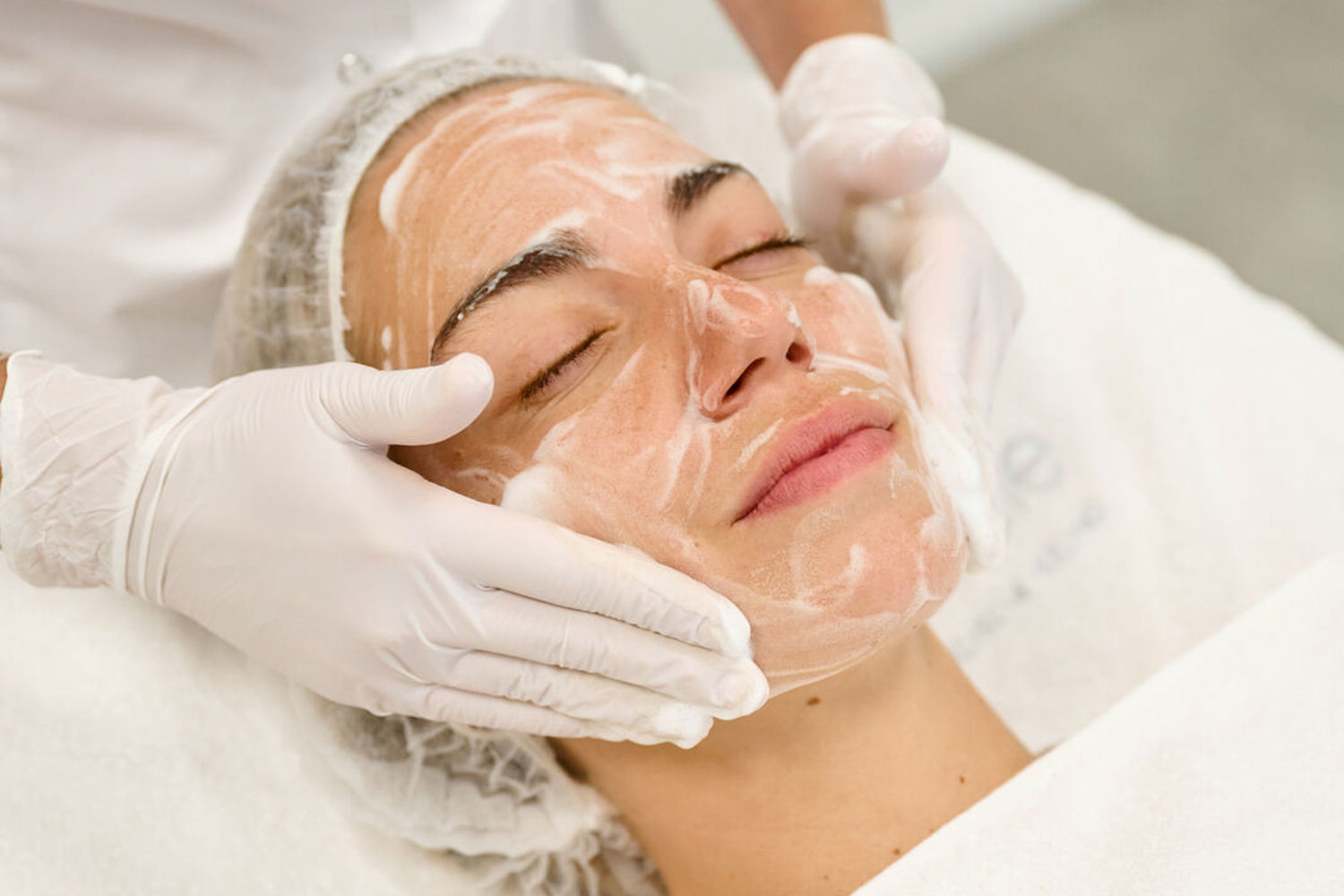 Acne Peeling Amsterdam