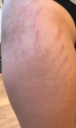 Striae 1