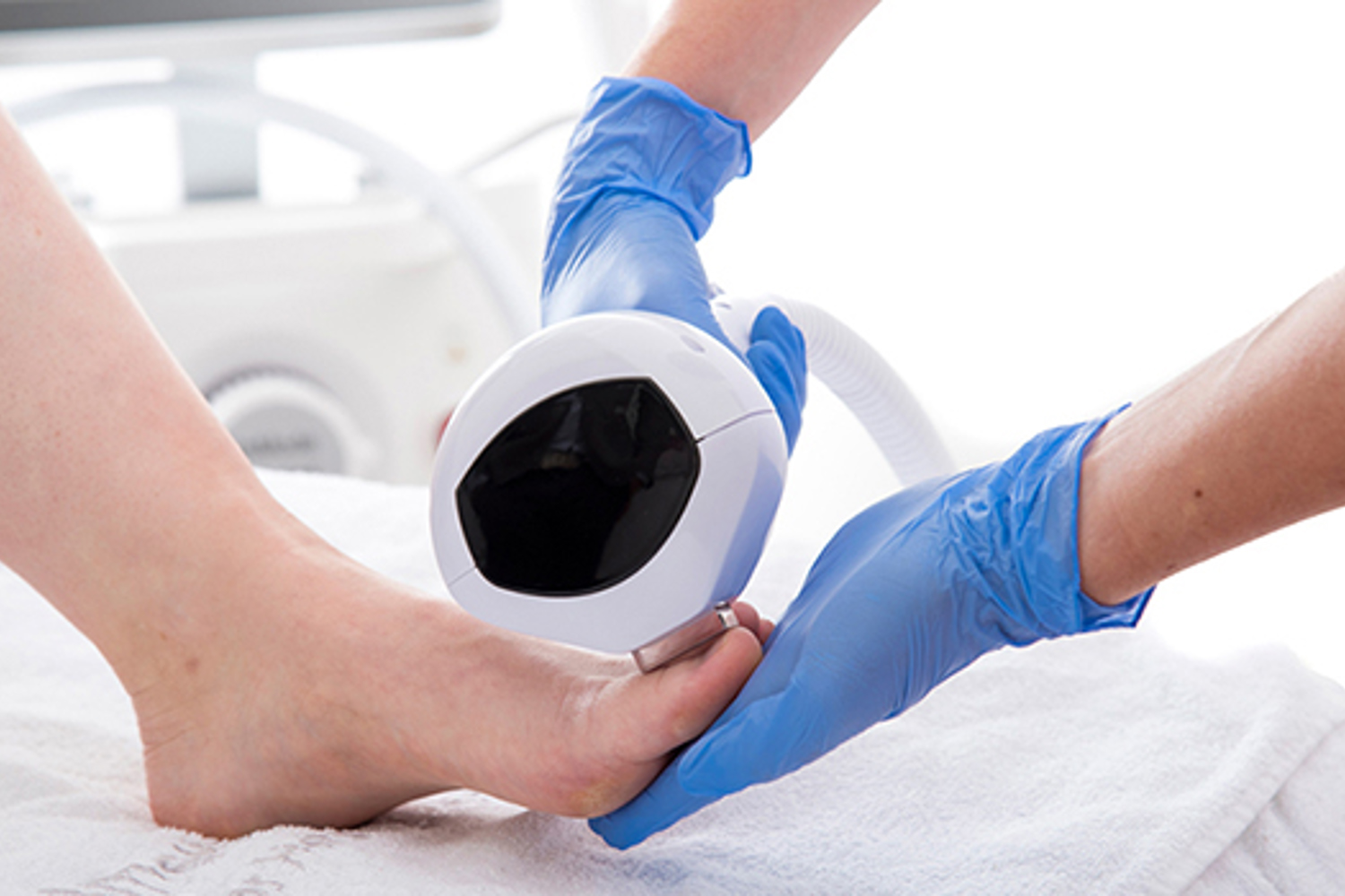 Schimmelnagels Laser Behandeling