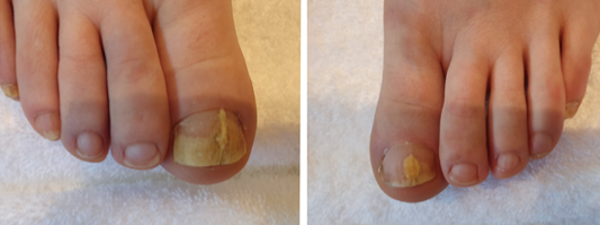 Traitement Mycose De L'ongle 1