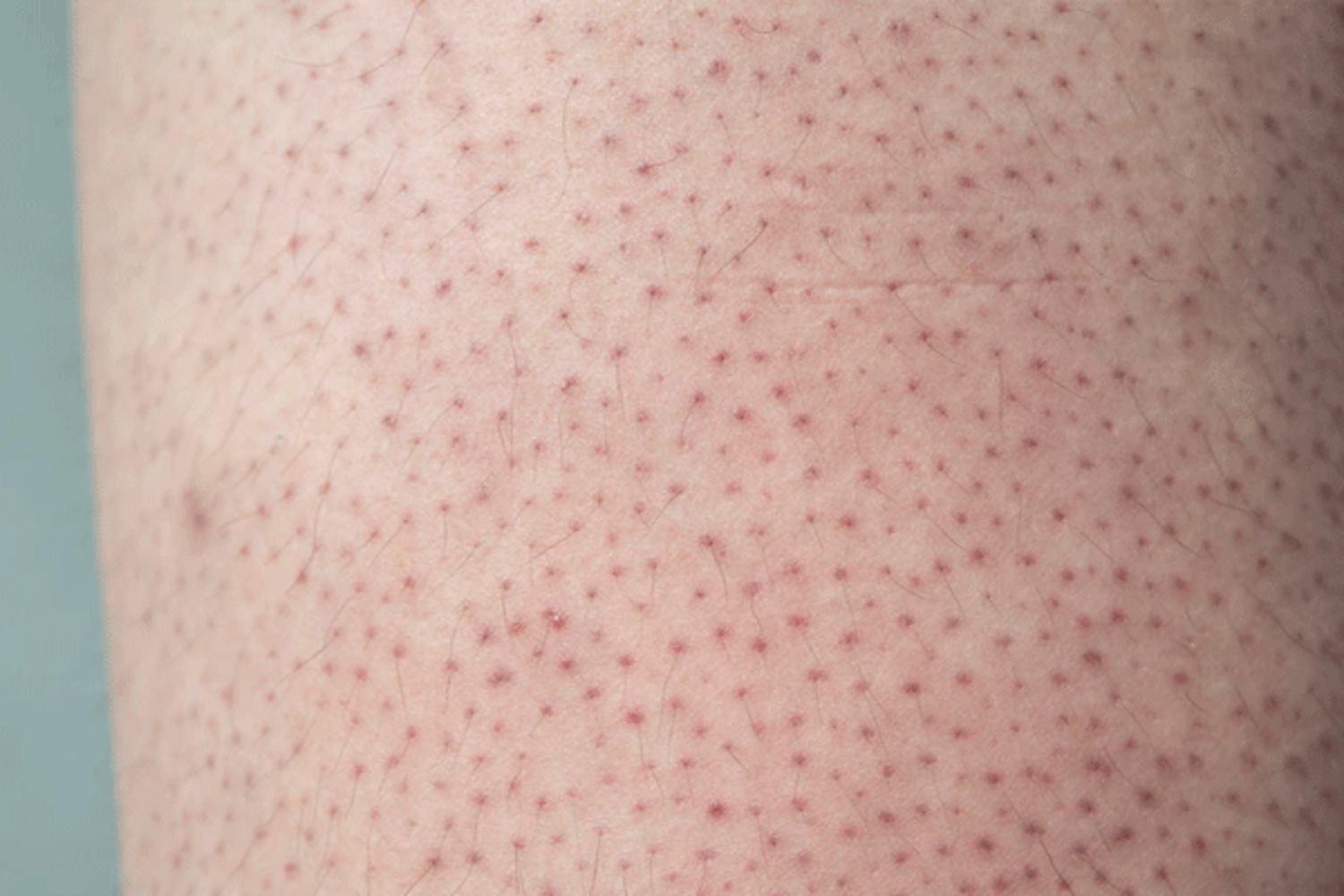 Strawberry Legs Ingegroeide Haartjes