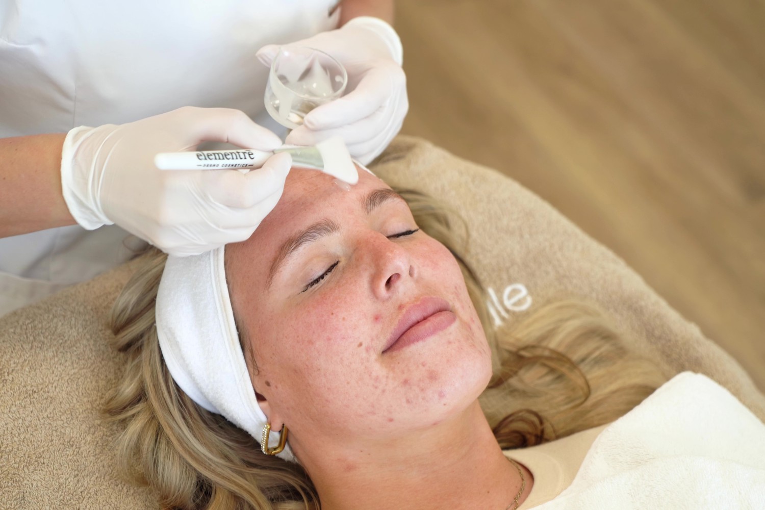 Acne Bij PCOS