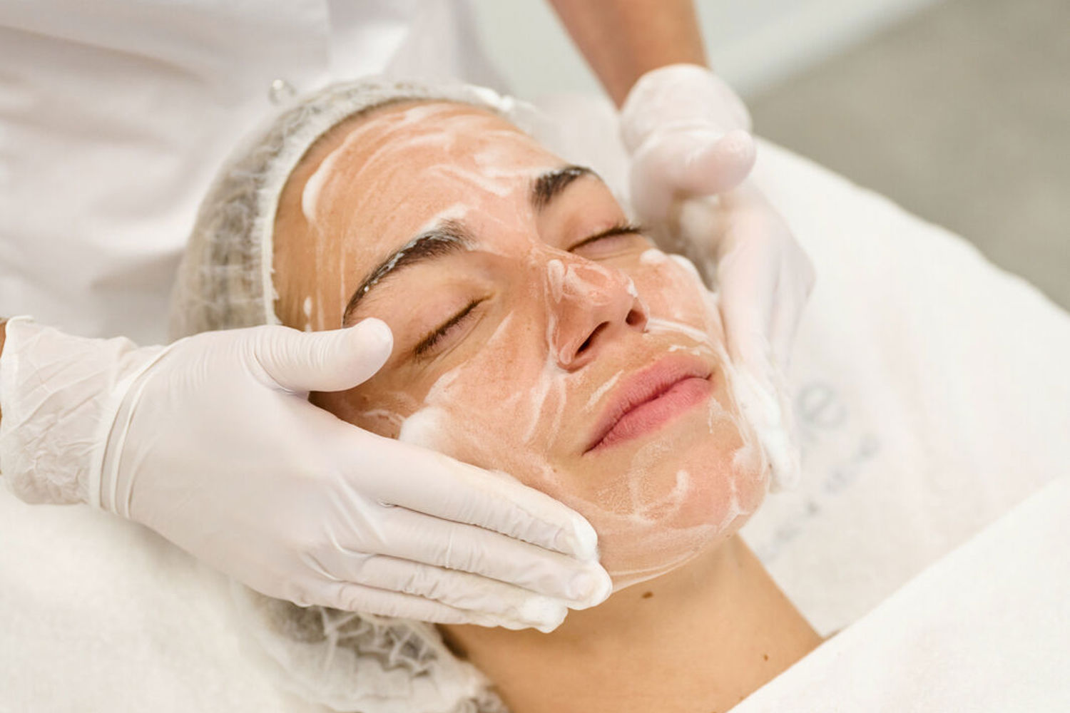 Acne peeling