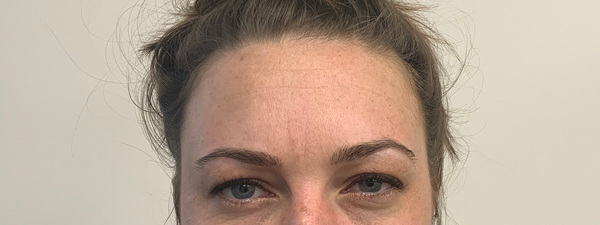 Resultaat Injectable Bocouture Botox Behandeling Van Frederique 14 2 OOK VOOR EXTERN Na