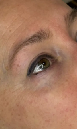 Total Eye Result 5 After