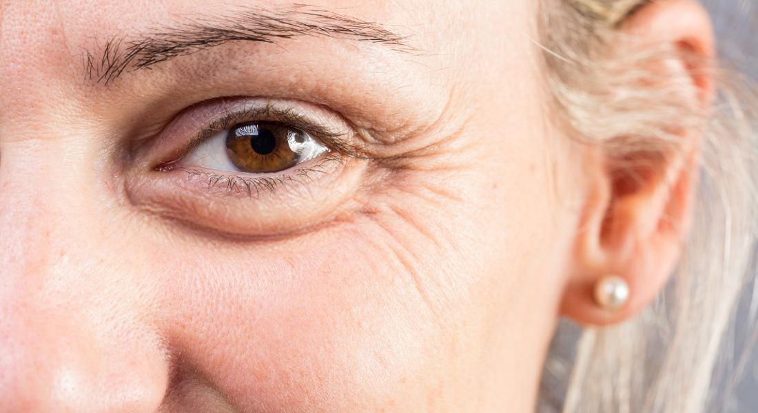 Kraaienpootjes met botox