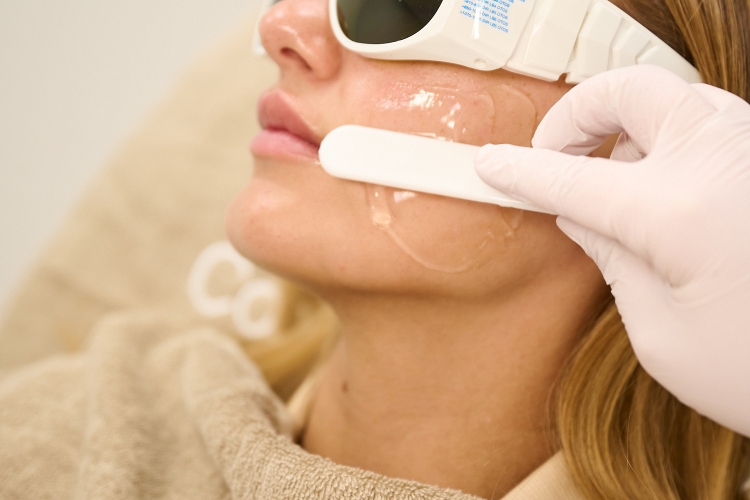 Bovenlip Laser Ontharen Gladde Huid