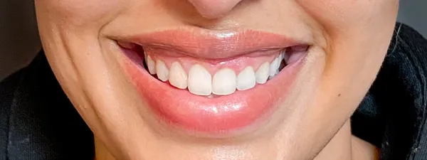 Botox Sourire Avant