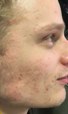 Résultat Cicatrices D'acne 32