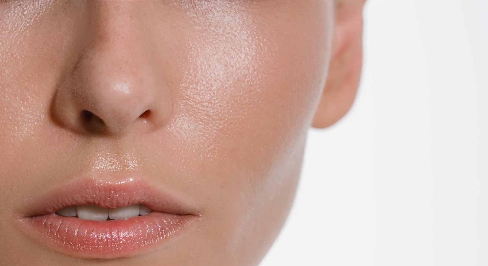Sublimation des pommettes avec des fillers