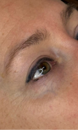 Microneedling Rondom Ogen Resultaat 1
