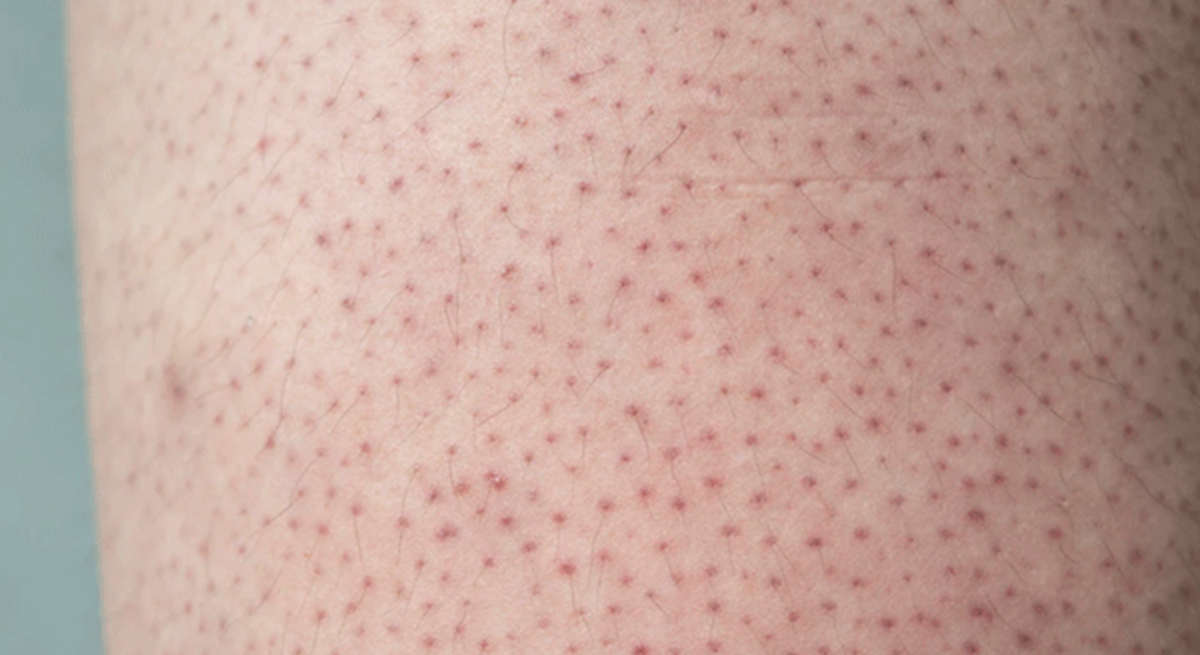 Alles über dunkle Punkte auf deinen Beinen Cosmetique Totale