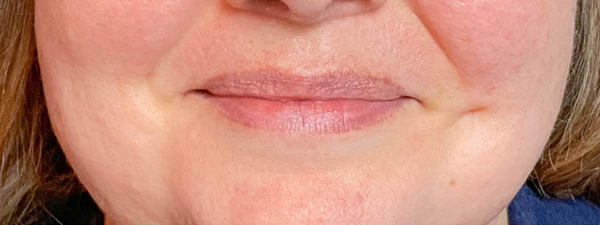 Lipfillers 4