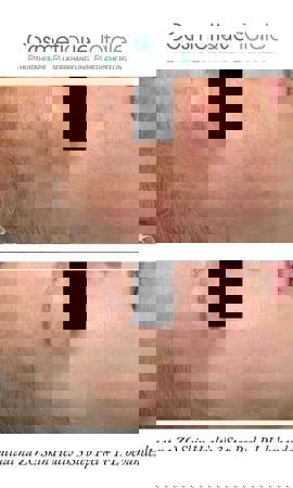 3 Stufen Peeling Zo Skin Health