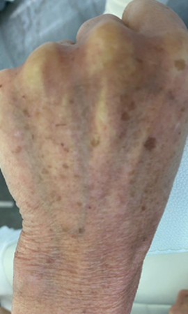 Taches Pigmentaires Mains 2