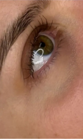 Total Eye Result 3 Before