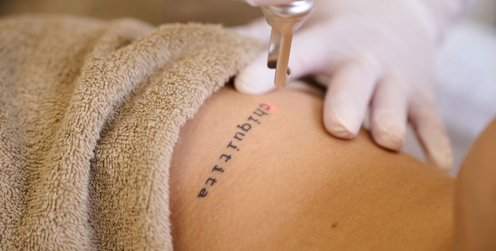 7 Veelgestelde Vragen Over Tattoo Laseren Waar Je Het Antwoord Op Moet Weten