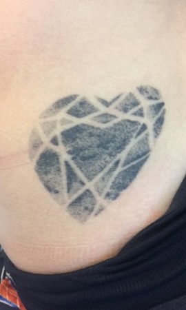 Tatoeage verwijderen voor