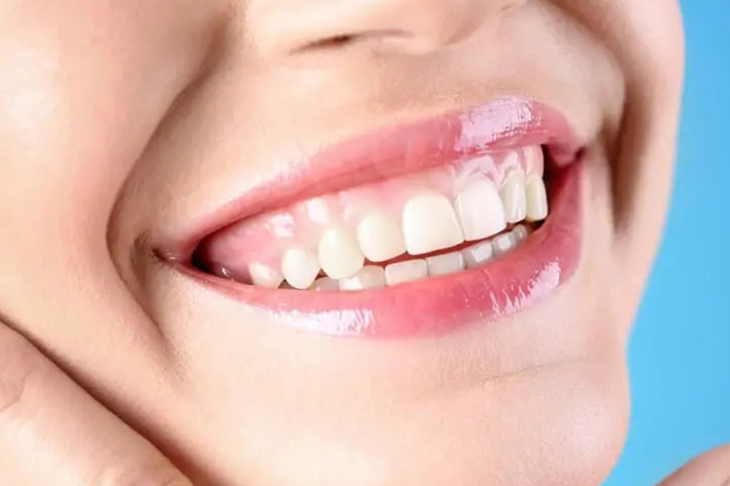 Sourrire Gingival