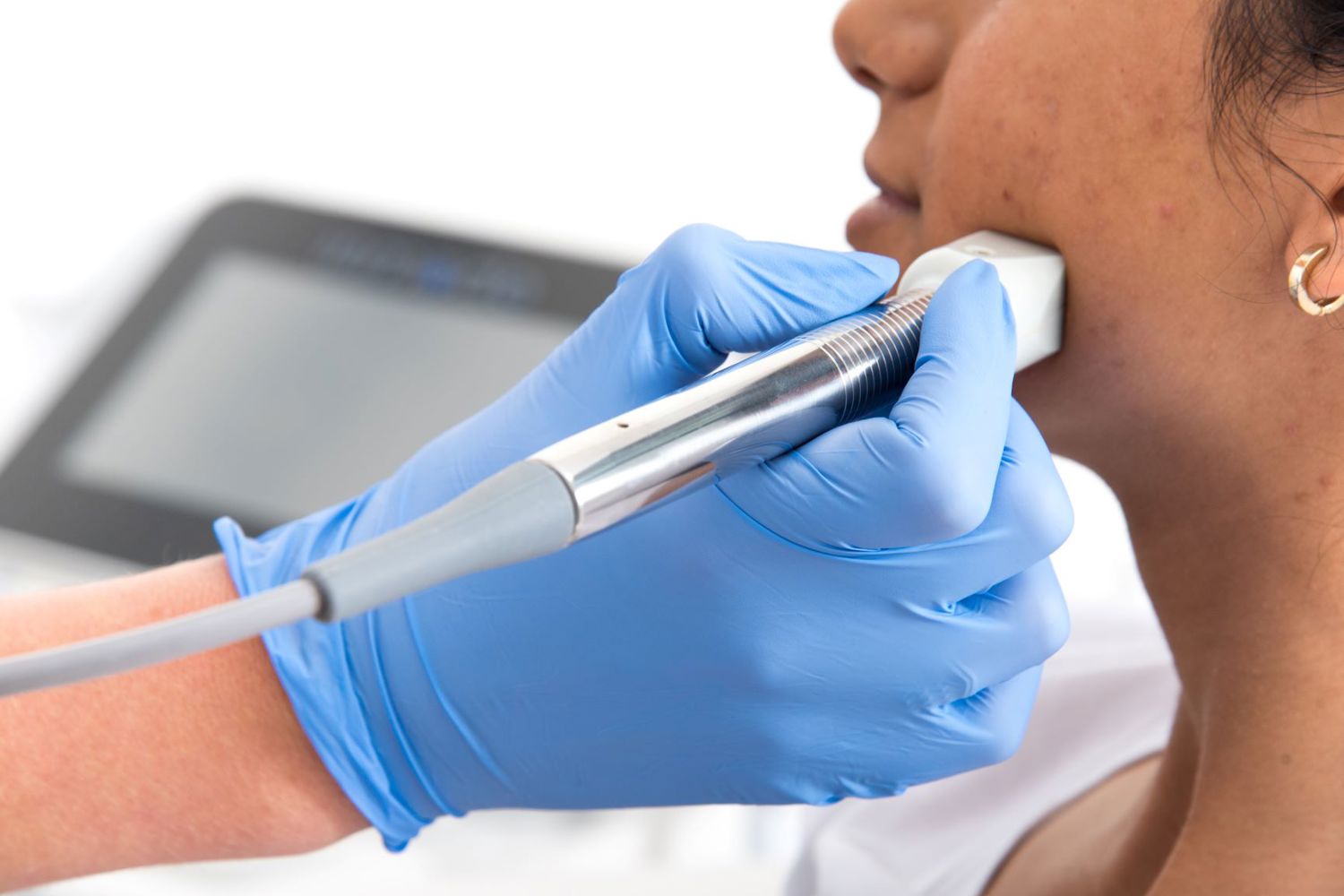 Fractionele Laser Fractora