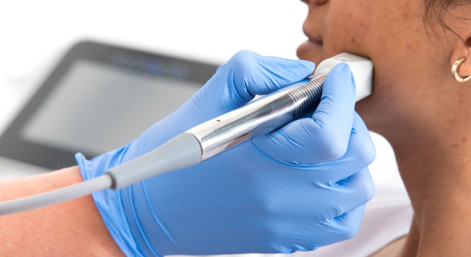 Fractionele Laser Fractora