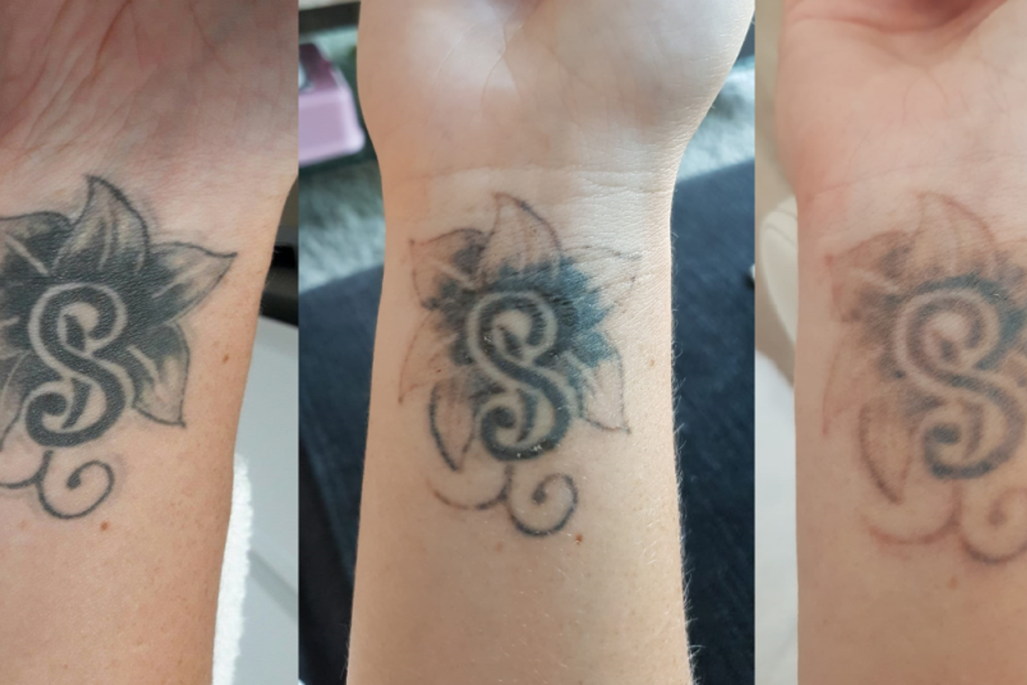 Tattoo Laseren Ervaringen