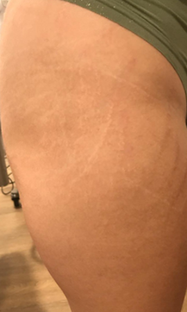 Striae 12