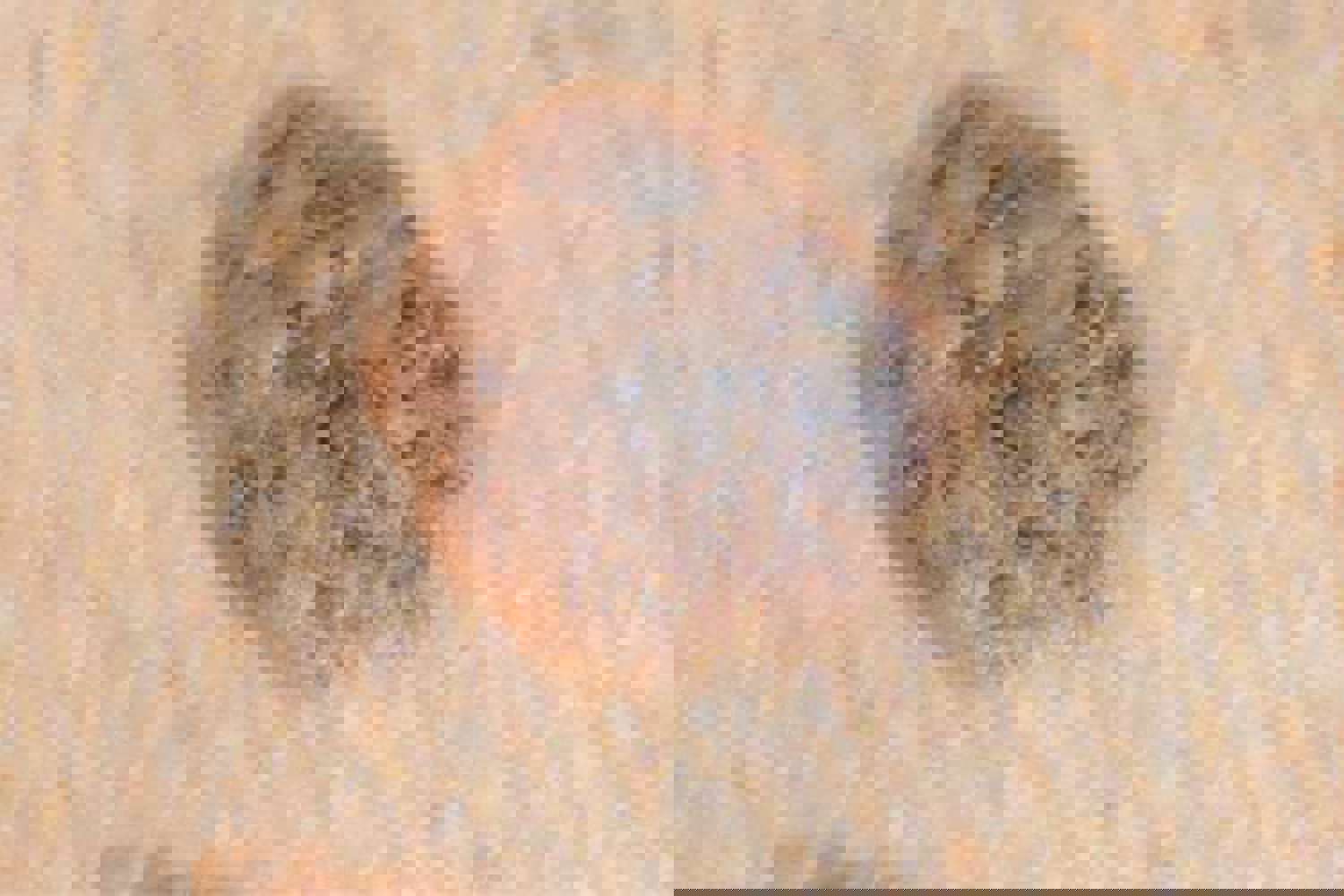 Seborrheic Keratoses
