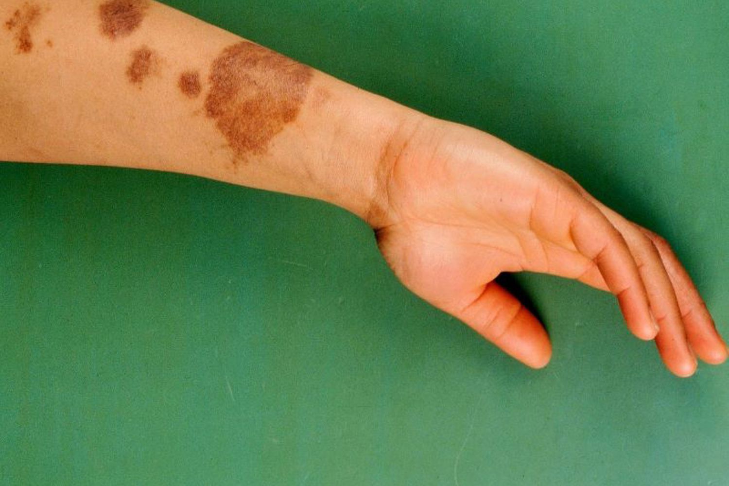 Postinflammatoire Hyperpigmentatie