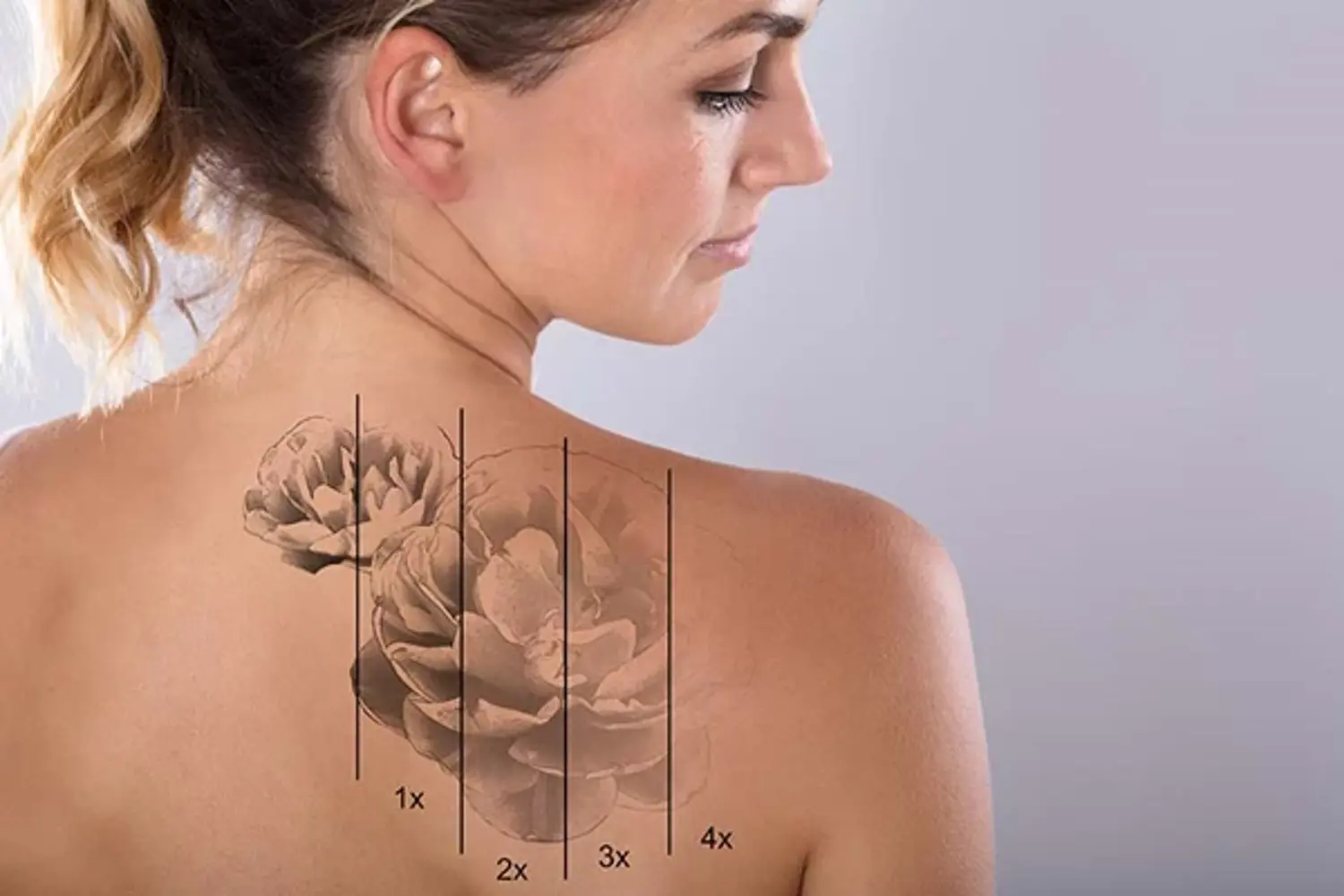 Tattoo Verwijderen (2)