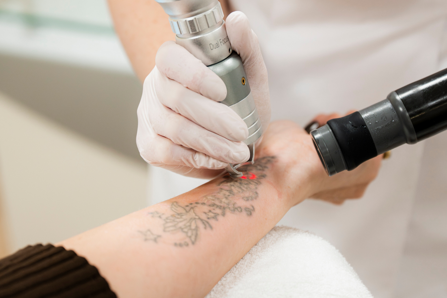 Tattoo Verwijderen Actie