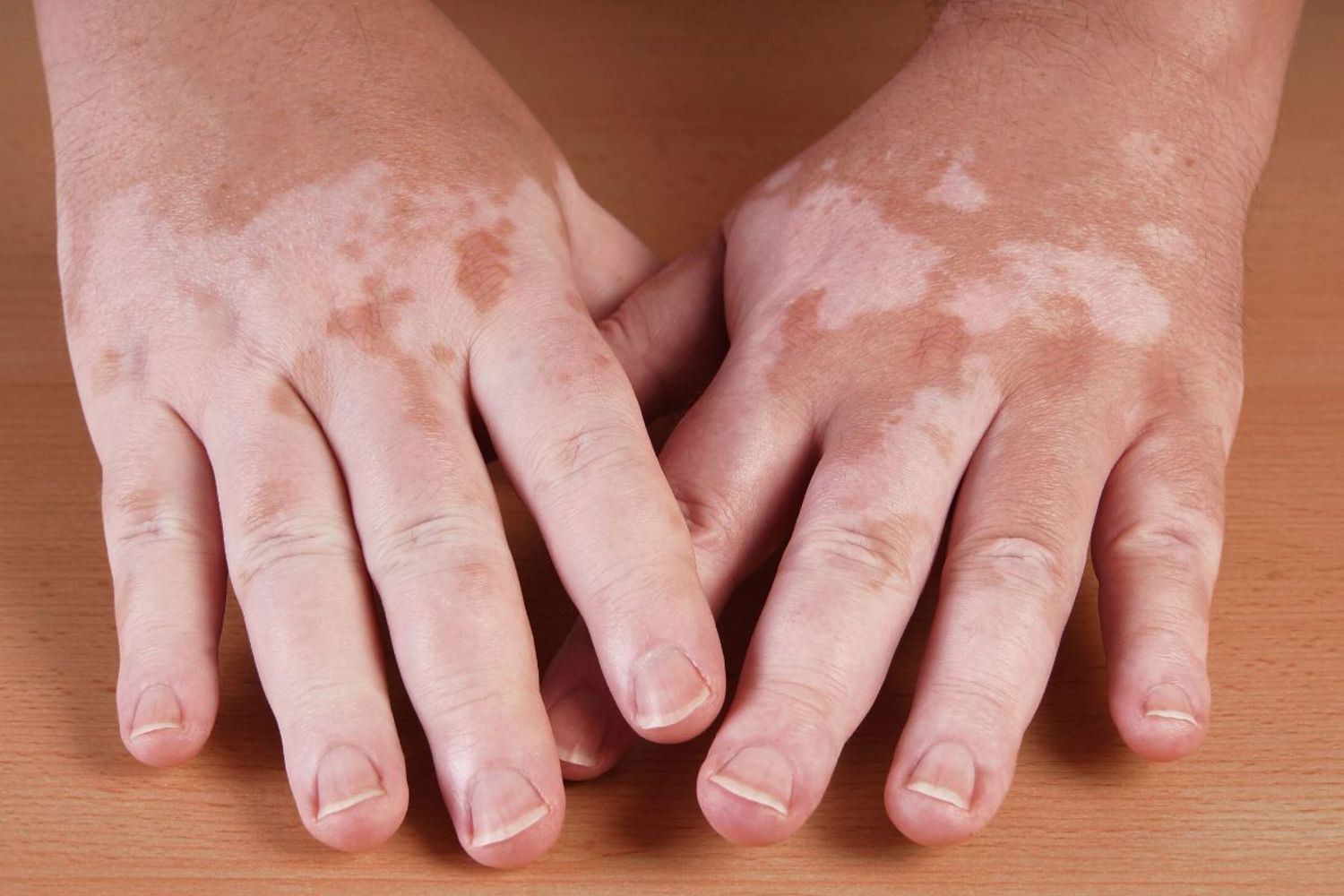 Vitiligo