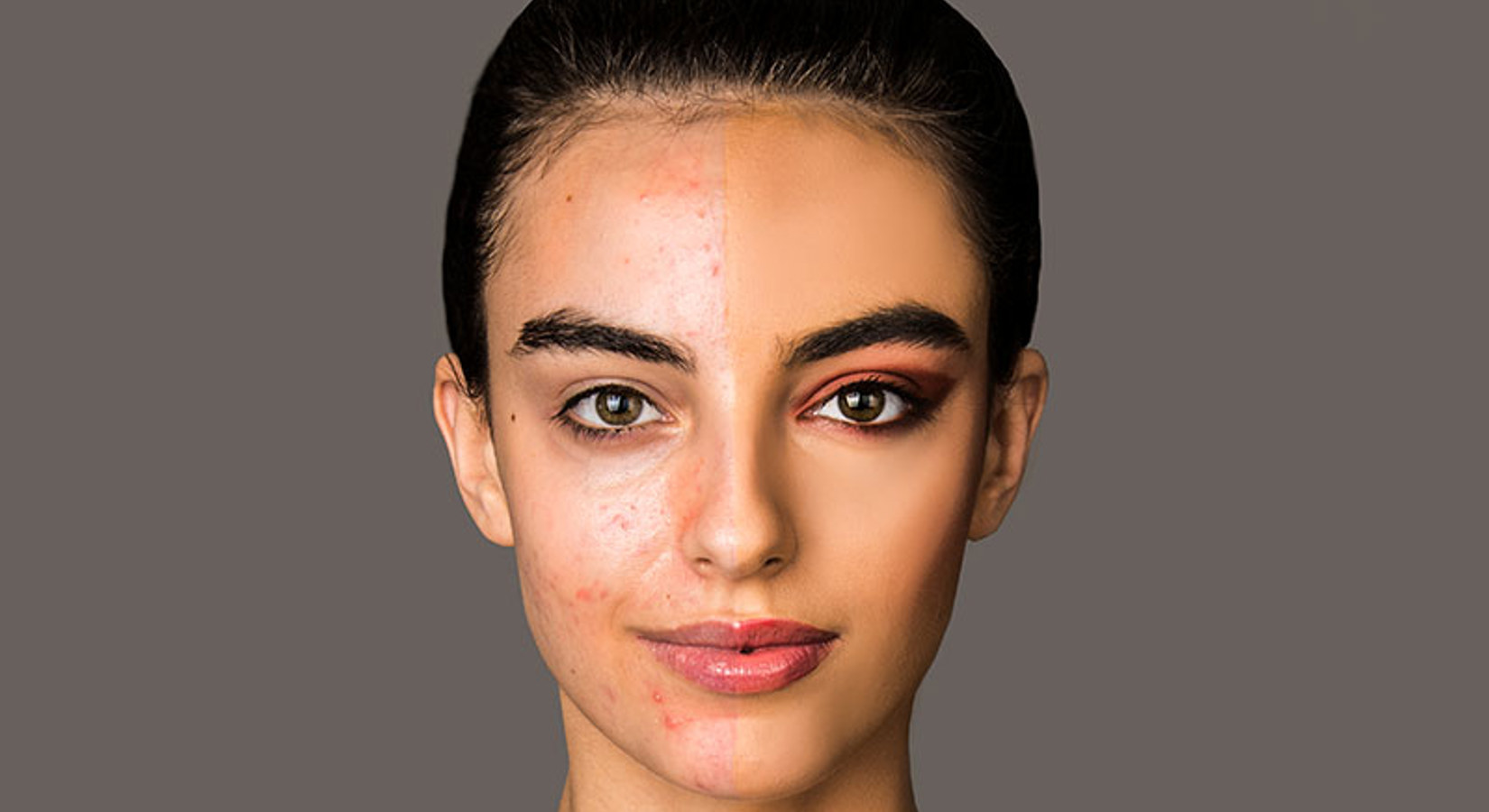 Acne Make Up
