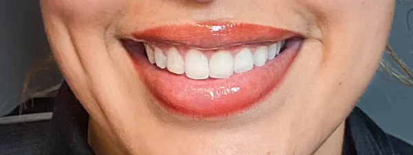Botox Sourire Apres