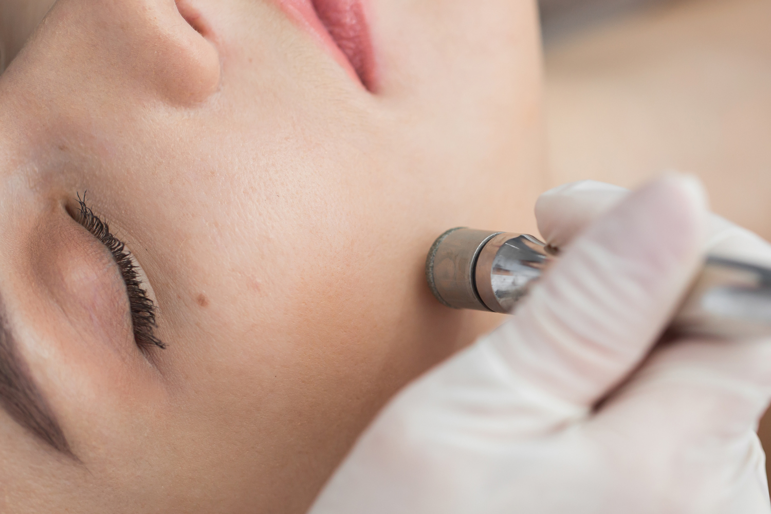 Microneedling Behandleing