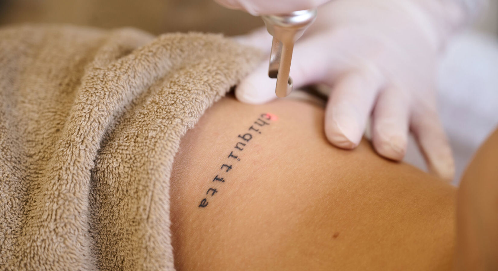 Tattoo Laseren Breda