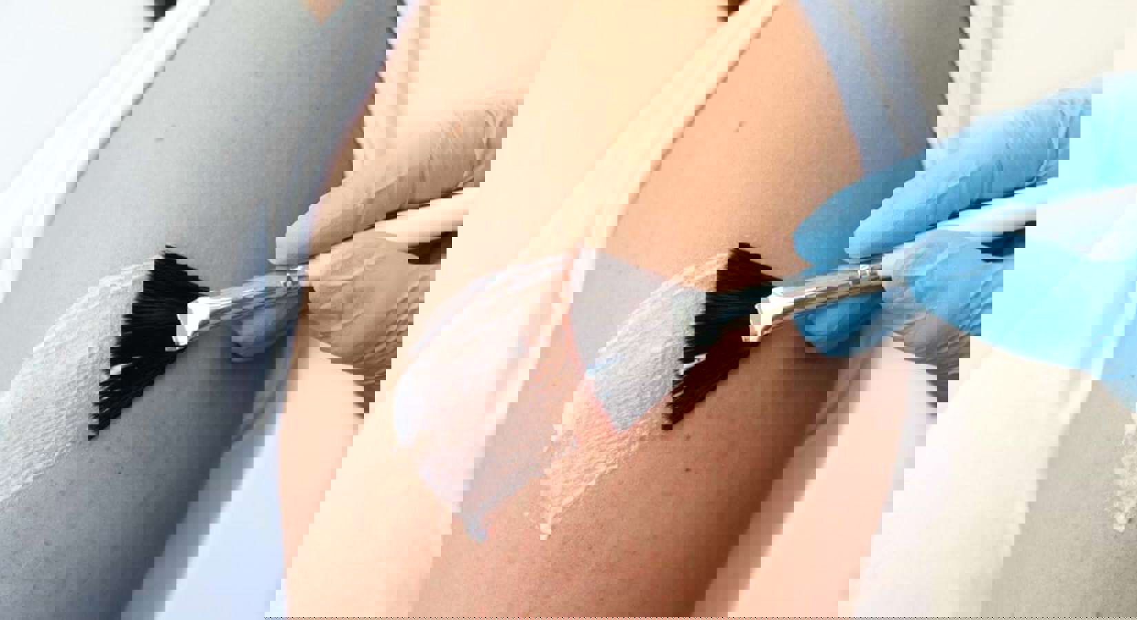Keratosis Pilaris
