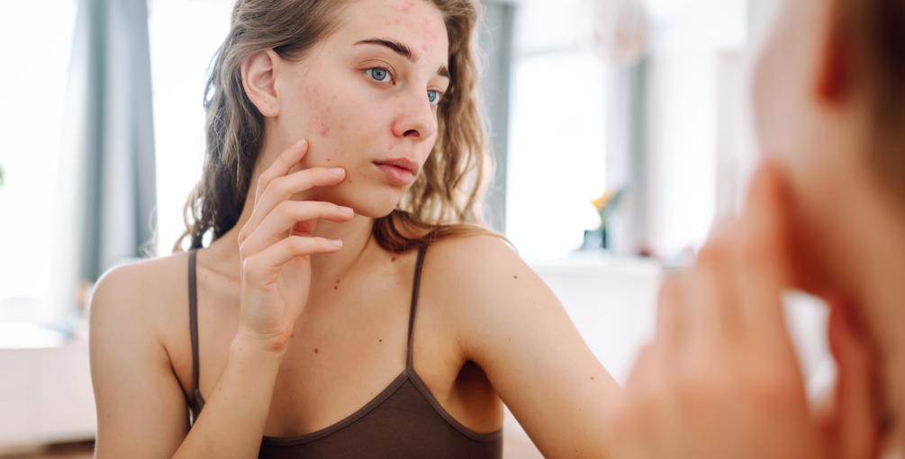 De Meest Voorkomende Oorzaken Van Acne Op Een Rijtje (1)