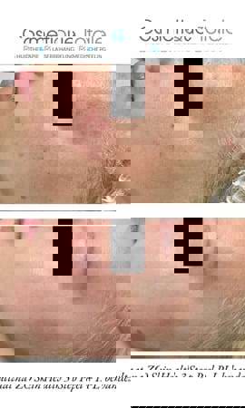 3 Stufen Peeling