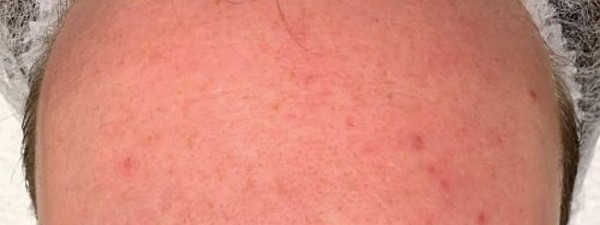 Acne Behandeling Resultaat (3)